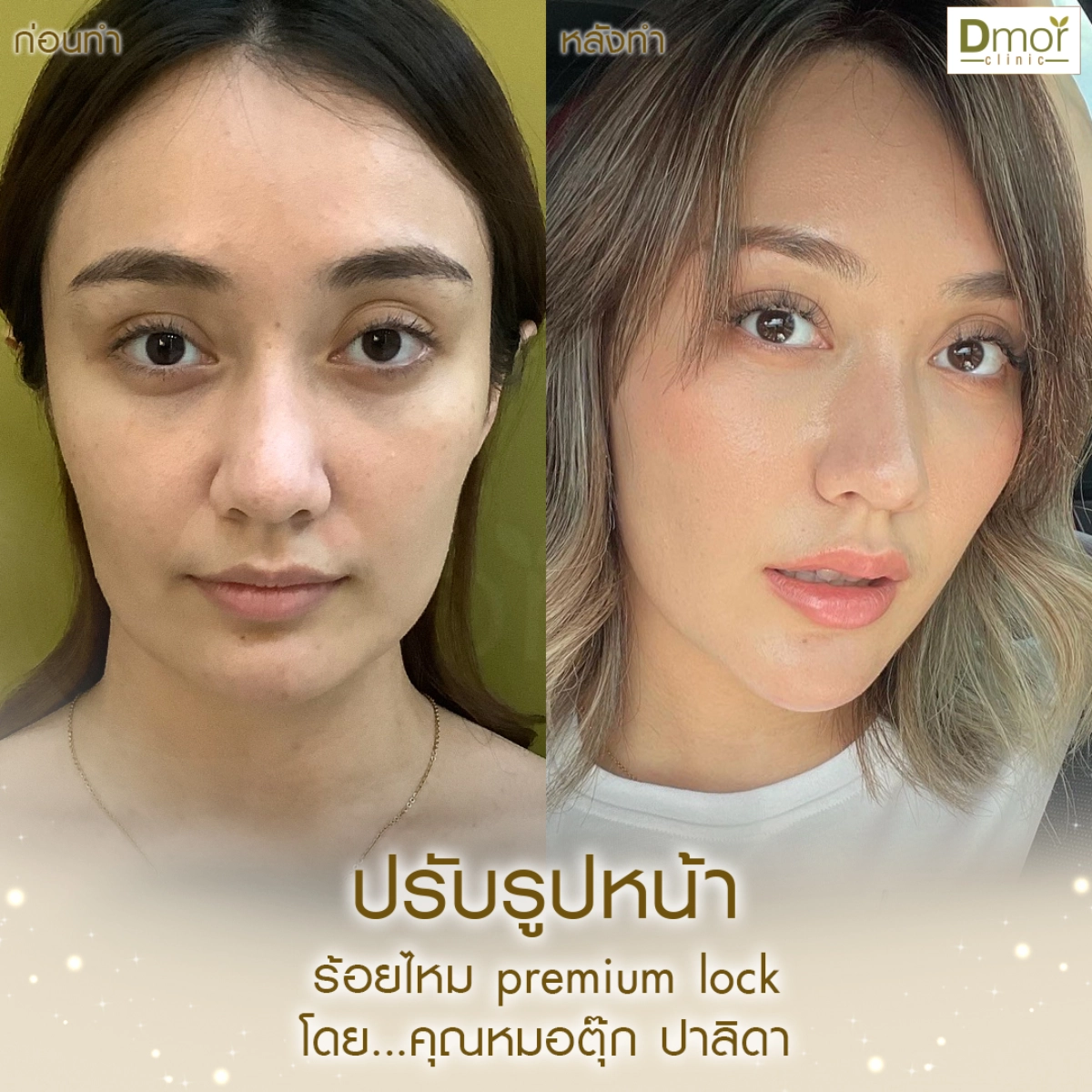 ปรับรูปหน้า-011
