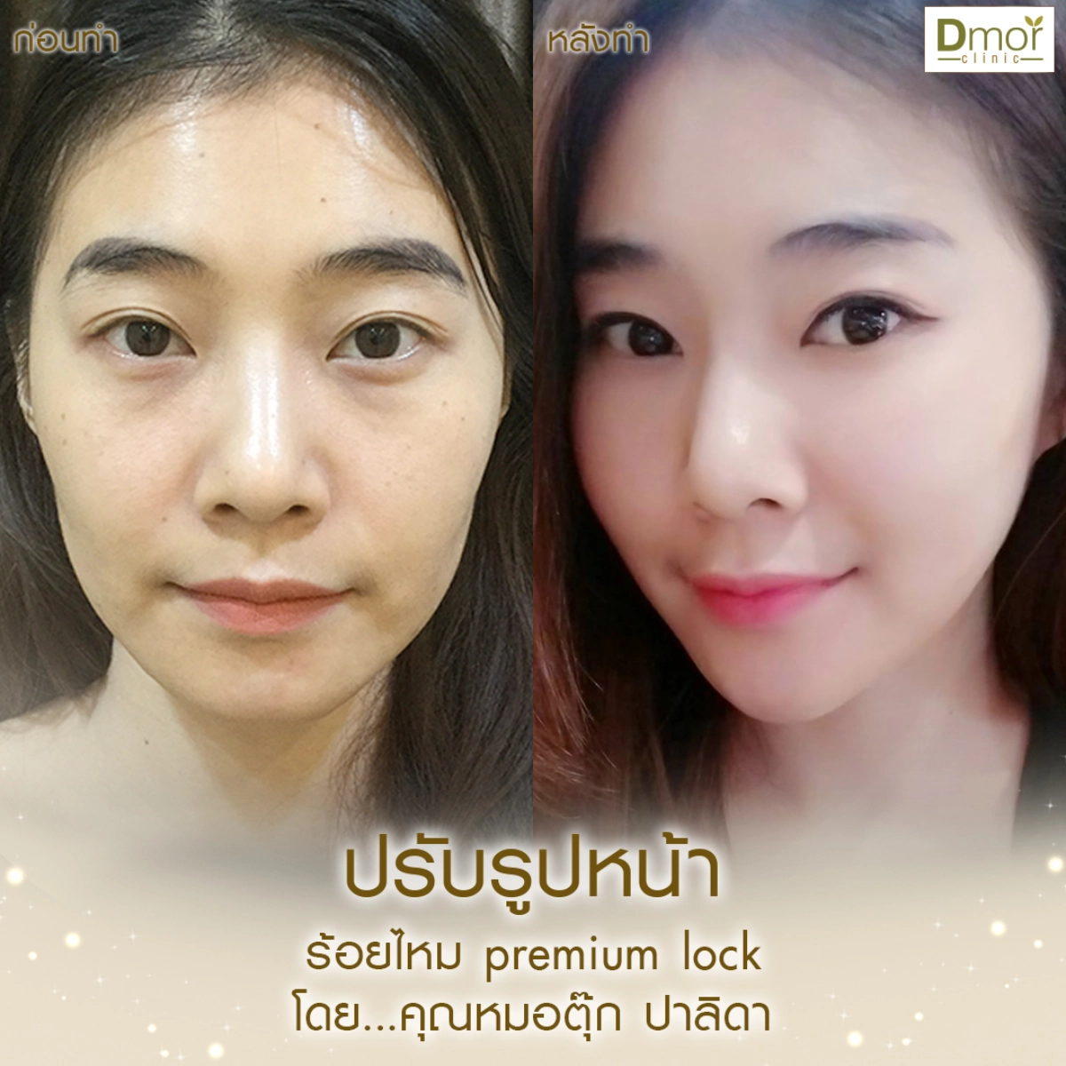 ปรับรูปหน้า-012